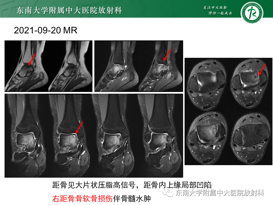 影像PPT - 【PPT】剥脱性骨软骨病-31