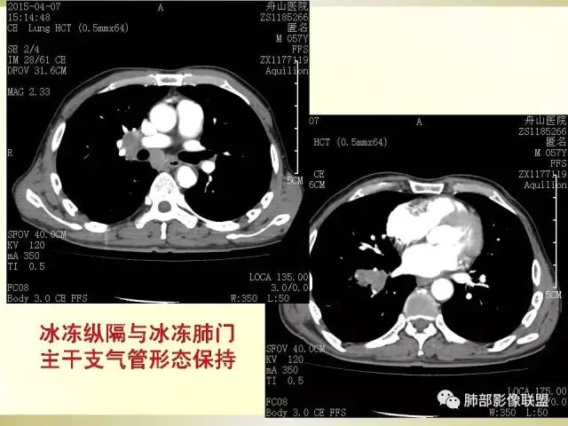 影像PPT - 【PPT】小细胞肺癌的病理影像分析-5 影像PPT - 【PPT】小细胞肺癌的病理影像分析-5