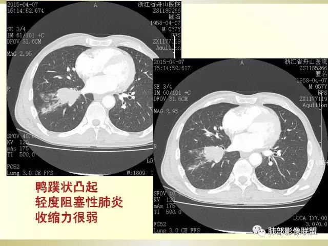 影像PPT - 【PPT】小细胞肺癌的病理影像分析-6 影像PPT - 【PPT】小细胞肺癌的病理影像分析-6