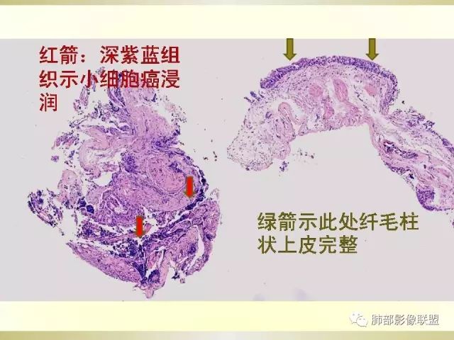 影像PPT - 【PPT】小细胞肺癌的病理影像分析-7 影像PPT - 【PPT】小细胞肺癌的病理影像分析-7