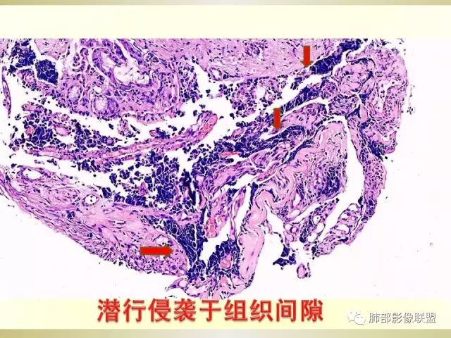 影像PPT - 【PPT】小细胞肺癌的病理影像分析-8 影像PPT - 【PPT】小细胞肺癌的病理影像分析-8