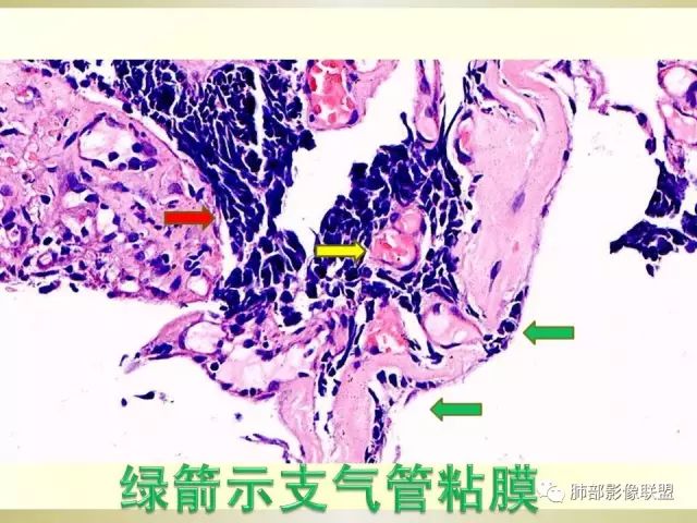 影像PPT - 【PPT】小细胞肺癌的病理影像分析-9 影像PPT - 【PPT】小细胞肺癌的病理影像分析-9