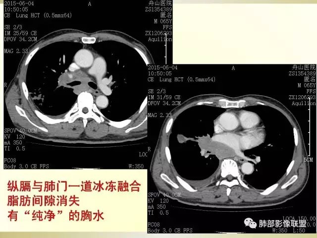 影像PPT - 【PPT】小细胞肺癌的病理影像分析-13 影像PPT - 【PPT】小细胞肺癌的病理影像分析-13