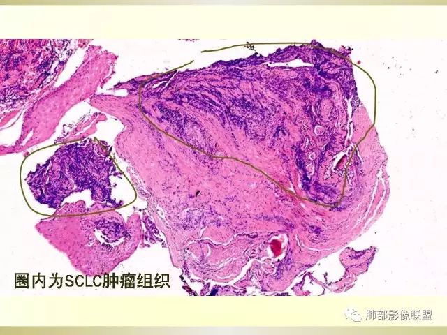 影像PPT - 【PPT】小细胞肺癌的病理影像分析-14 影像PPT - 【PPT】小细胞肺癌的病理影像分析-14