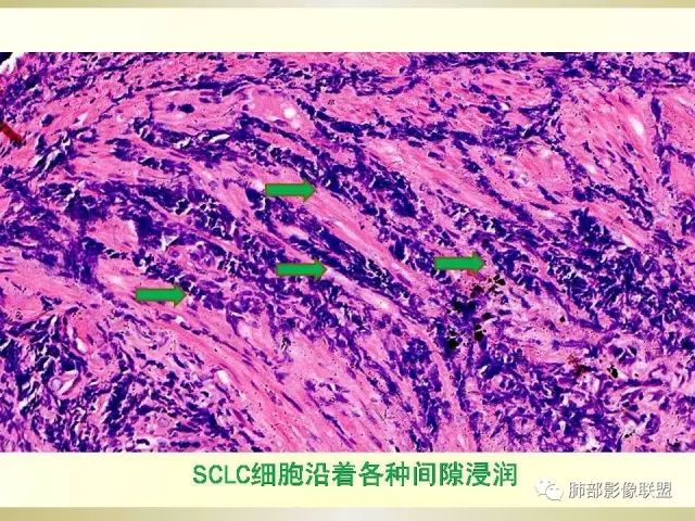 影像PPT - 【PPT】小细胞肺癌的病理影像分析-15 影像PPT - 【PPT】小细胞肺癌的病理影像分析-15