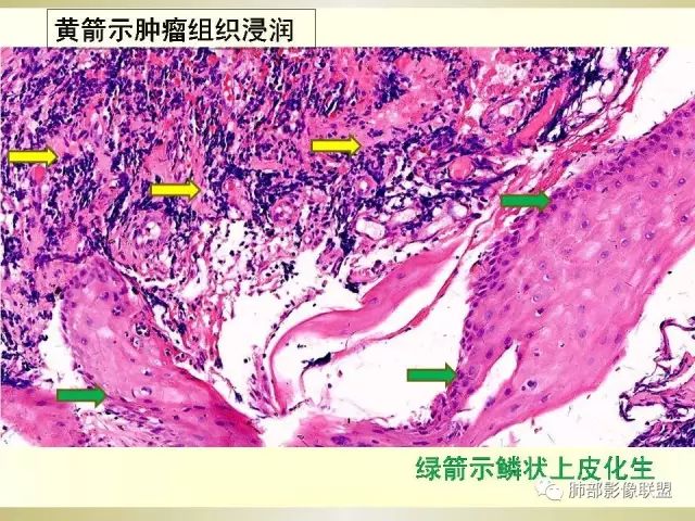 影像PPT - 【PPT】小细胞肺癌的病理影像分析-16 影像PPT - 【PPT】小细胞肺癌的病理影像分析-16