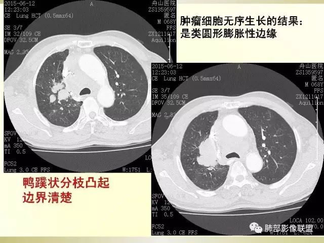 影像PPT - 【PPT】小细胞肺癌的病理影像分析-17 影像PPT - 【PPT】小细胞肺癌的病理影像分析-17