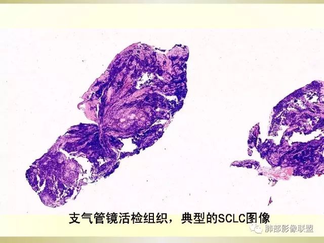 影像PPT - 【PPT】小细胞肺癌的病理影像分析-18 影像PPT - 【PPT】小细胞肺癌的病理影像分析-18