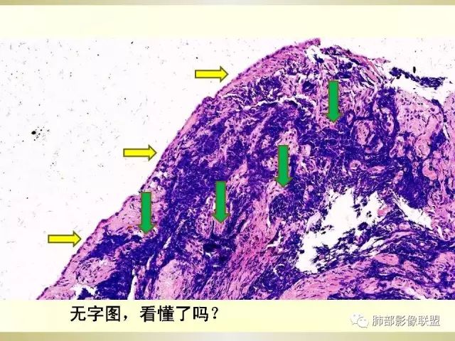 影像PPT - 【PPT】小细胞肺癌的病理影像分析-19 影像PPT - 【PPT】小细胞肺癌的病理影像分析-19