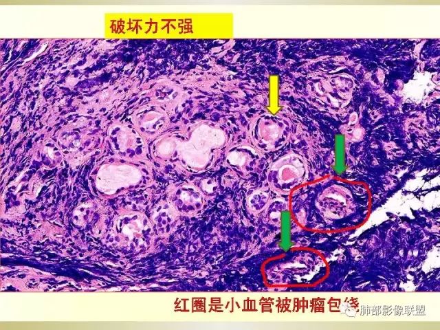 影像PPT - 【PPT】小细胞肺癌的病理影像分析-21 影像PPT - 【PPT】小细胞肺癌的病理影像分析-21