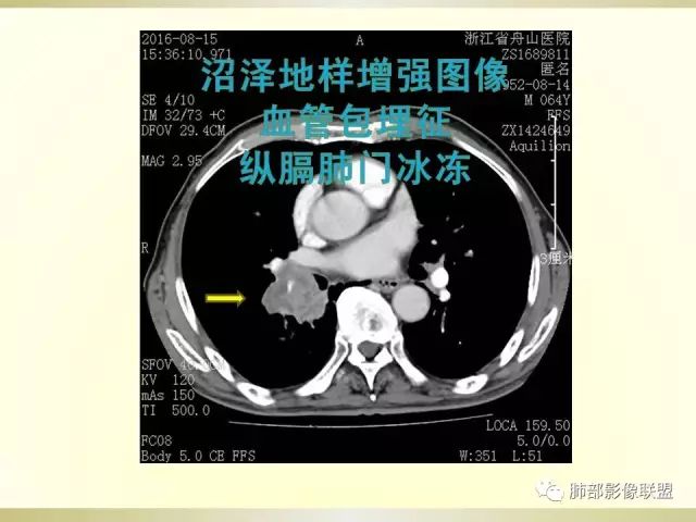 影像PPT - 【PPT】小细胞肺癌的病理影像分析-23 影像PPT - 【PPT】小细胞肺癌的病理影像分析-23