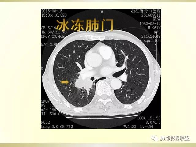 影像PPT - 【PPT】小细胞肺癌的病理影像分析-24 影像PPT - 【PPT】小细胞肺癌的病理影像分析-24