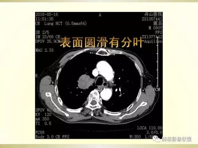 影像PPT - 【PPT】小细胞肺癌的病理影像分析-25 影像PPT - 【PPT】小细胞肺癌的病理影像分析-25