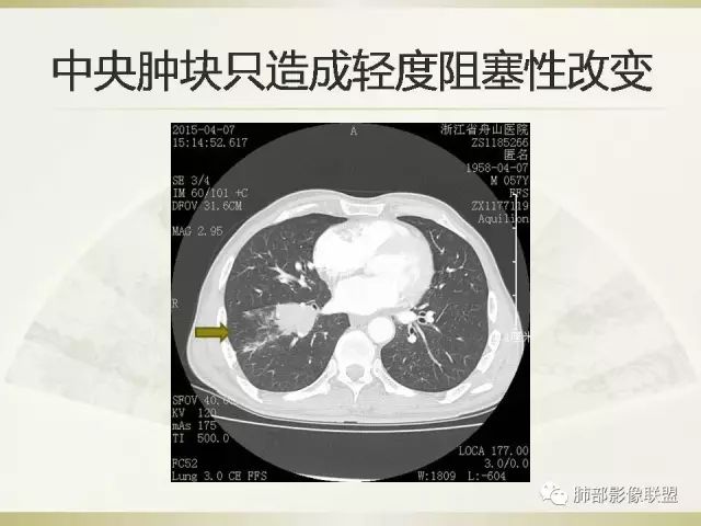 影像PPT - 【PPT】小细胞肺癌的病理影像分析-28 影像PPT - 【PPT】小细胞肺癌的病理影像分析-28