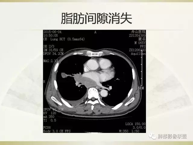 影像PPT - 【PPT】小细胞肺癌的病理影像分析-32 影像PPT - 【PPT】小细胞肺癌的病理影像分析-32