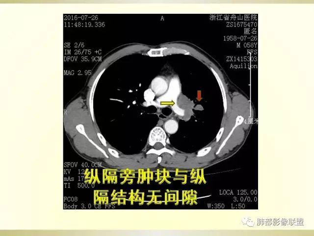 影像PPT - 【PPT】小细胞肺癌的病理影像分析-33 影像PPT - 【PPT】小细胞肺癌的病理影像分析-33