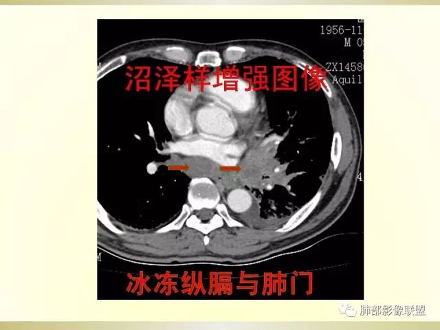 影像PPT - 【PPT】小细胞肺癌的病理影像分析-41 影像PPT - 【PPT】小细胞肺癌的病理影像分析-41