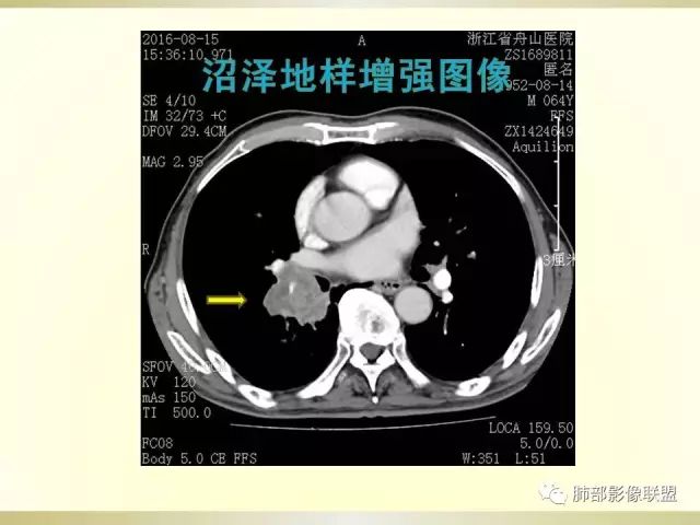 影像PPT - 【PPT】小细胞肺癌的病理影像分析-42 影像PPT - 【PPT】小细胞肺癌的病理影像分析-42