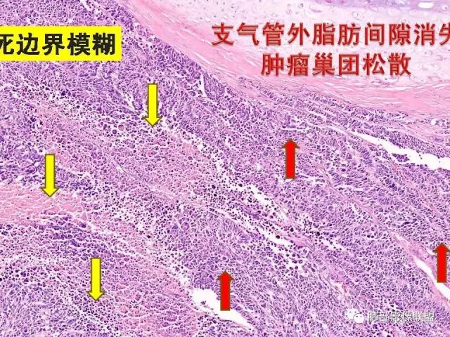影像PPT - 【PPT】小细胞肺癌的病理影像分析-43 影像PPT - 【PPT】小细胞肺癌的病理影像分析-43