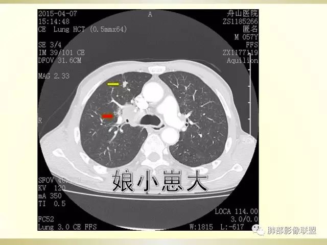 影像PPT - 【PPT】小细胞肺癌的病理影像分析-45 影像PPT - 【PPT】小细胞肺癌的病理影像分析-45