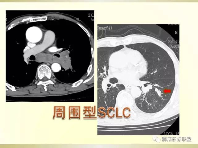 影像PPT - 【PPT】小细胞肺癌的病理影像分析-46 影像PPT - 【PPT】小细胞肺癌的病理影像分析-46