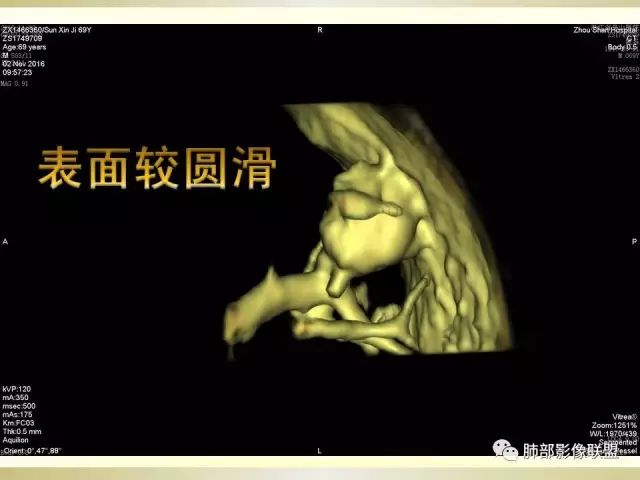 影像PPT - 【PPT】小细胞肺癌的病理影像分析-48 影像PPT - 【PPT】小细胞肺癌的病理影像分析-48