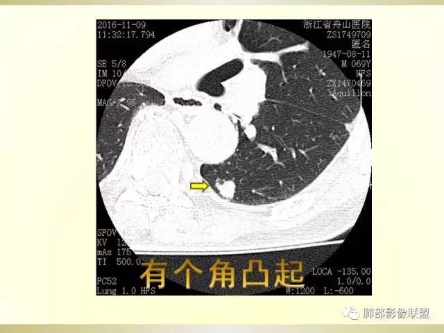 影像PPT - 【PPT】小细胞肺癌的病理影像分析-47 影像PPT - 【PPT】小细胞肺癌的病理影像分析-47