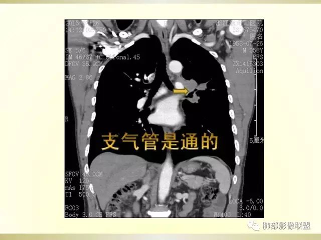 影像PPT - 【PPT】小细胞肺癌的病理影像分析-50 影像PPT - 【PPT】小细胞肺癌的病理影像分析-50