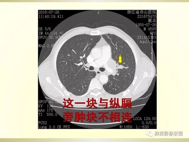 影像PPT - 【PPT】小细胞肺癌的病理影像分析-51 影像PPT - 【PPT】小细胞肺癌的病理影像分析-51