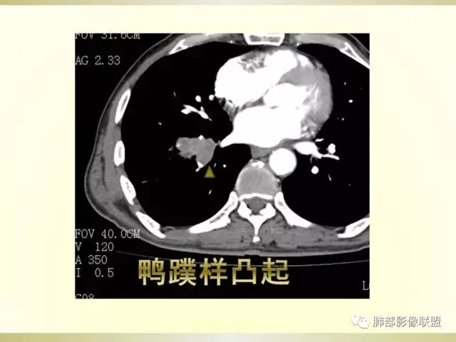 影像PPT - 【PPT】小细胞肺癌的病理影像分析-54 影像PPT - 【PPT】小细胞肺癌的病理影像分析-54