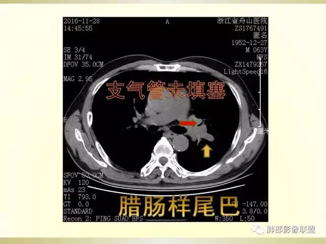 影像PPT - 【PPT】小细胞肺癌的病理影像分析-55 影像PPT - 【PPT】小细胞肺癌的病理影像分析-55
