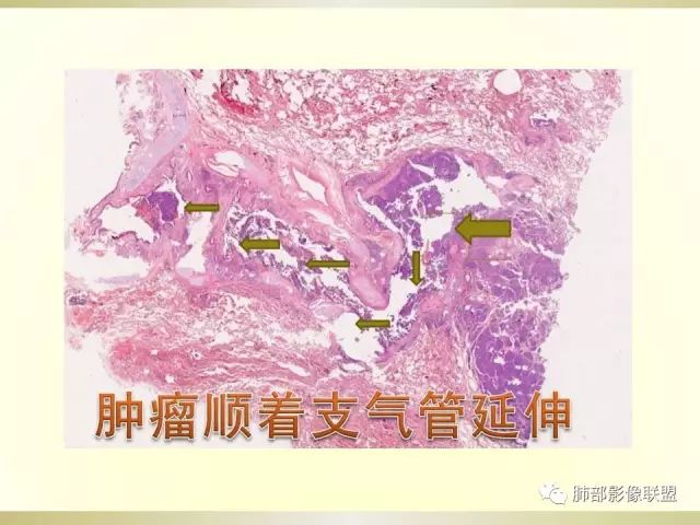 影像PPT - 【PPT】小细胞肺癌的病理影像分析-58 影像PPT - 【PPT】小细胞肺癌的病理影像分析-58