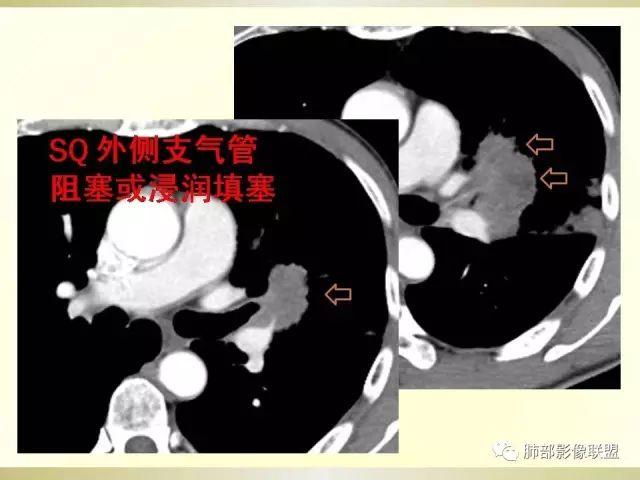 影像PPT - 【PPT】小细胞肺癌的病理影像分析-64 影像PPT - 【PPT】小细胞肺癌的病理影像分析-64