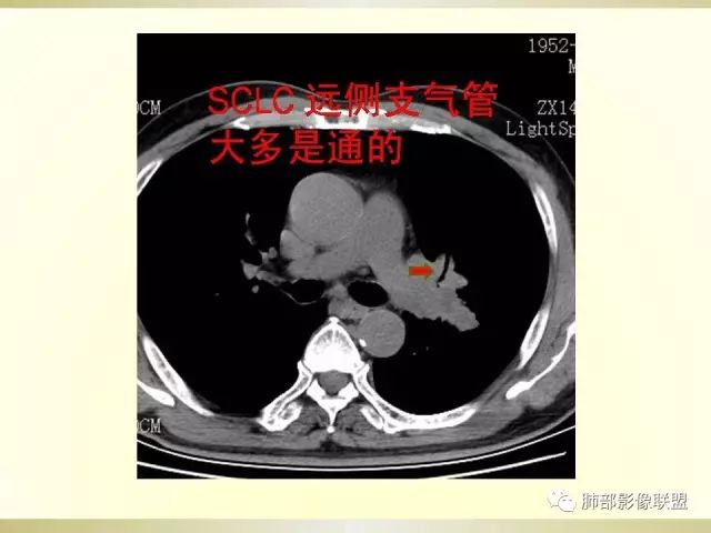 影像PPT - 【PPT】小细胞肺癌的病理影像分析-65 影像PPT - 【PPT】小细胞肺癌的病理影像分析-65