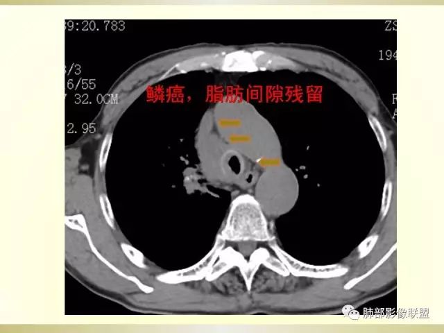 影像PPT - 【PPT】小细胞肺癌的病理影像分析-66 影像PPT - 【PPT】小细胞肺癌的病理影像分析-66