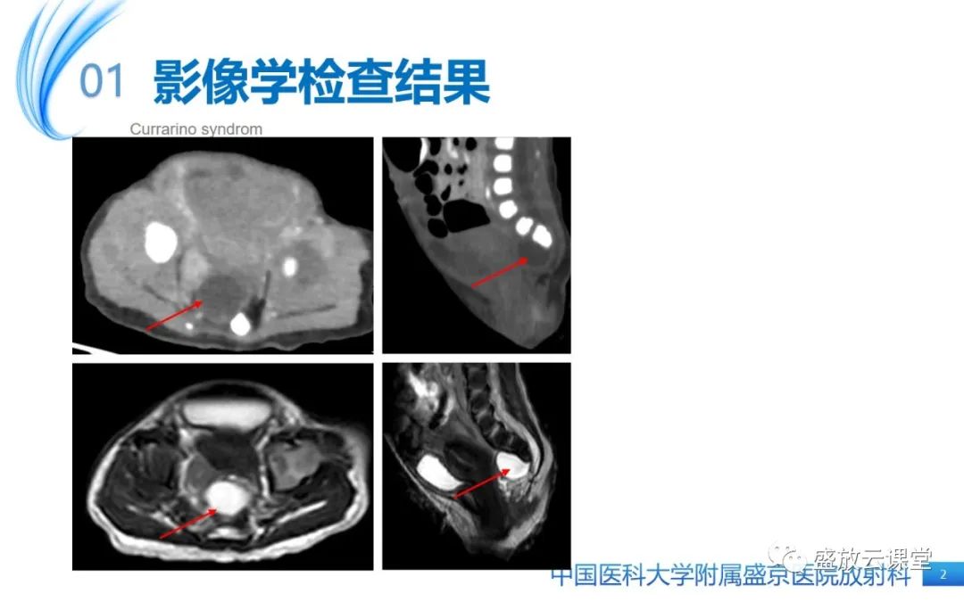 影像PPT - 【病例】Currarino综合征1例CT及MR影像-2