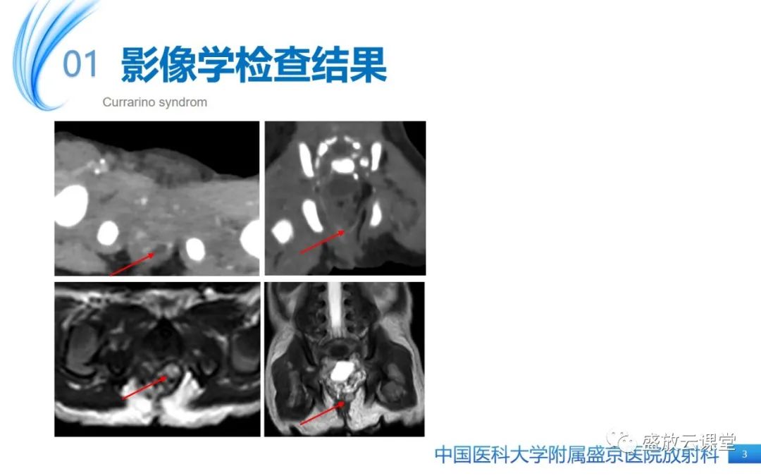 影像PPT - 【病例】Currarino综合征1例CT及MR影像-3