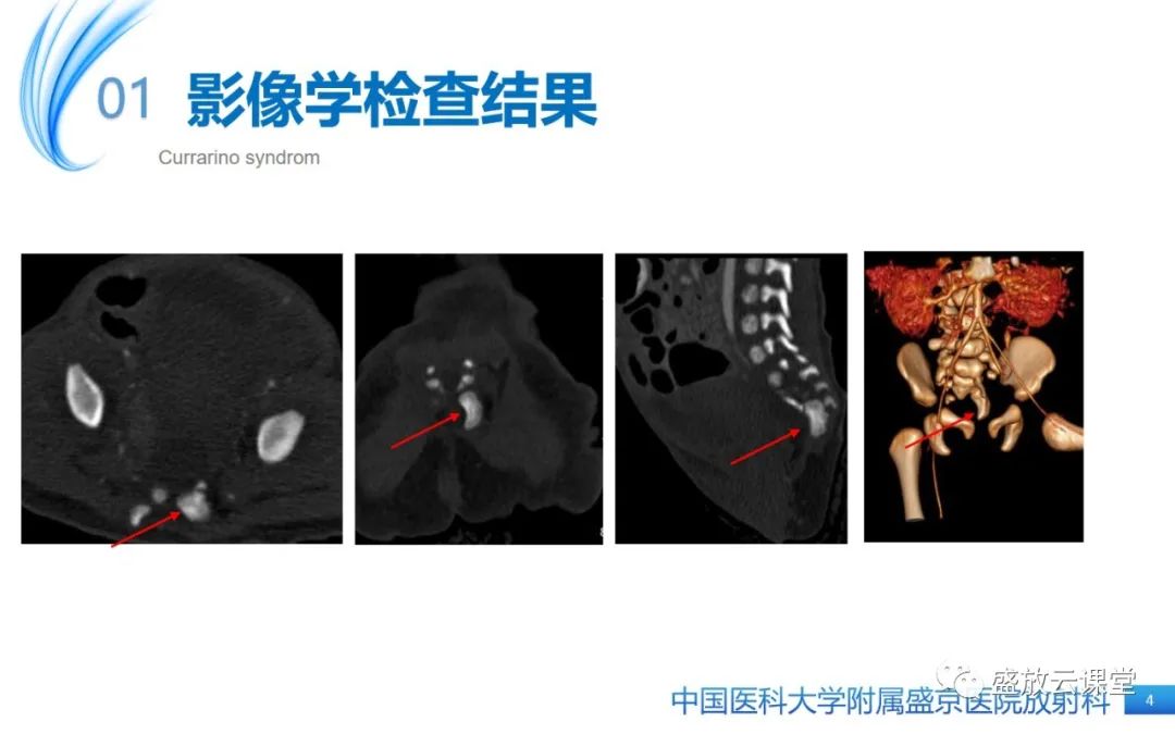 影像PPT - 【病例】Currarino综合征1例CT及MR影像-4