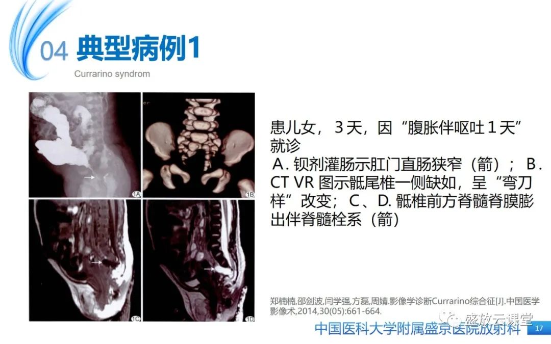 影像PPT - 【病例】Currarino综合征1例CT及MR影像-17