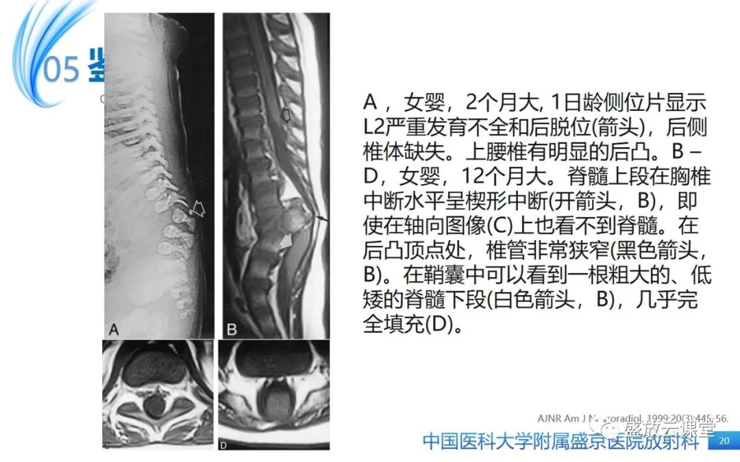 影像PPT - 【病例】Currarino综合征1例CT及MR影像-20