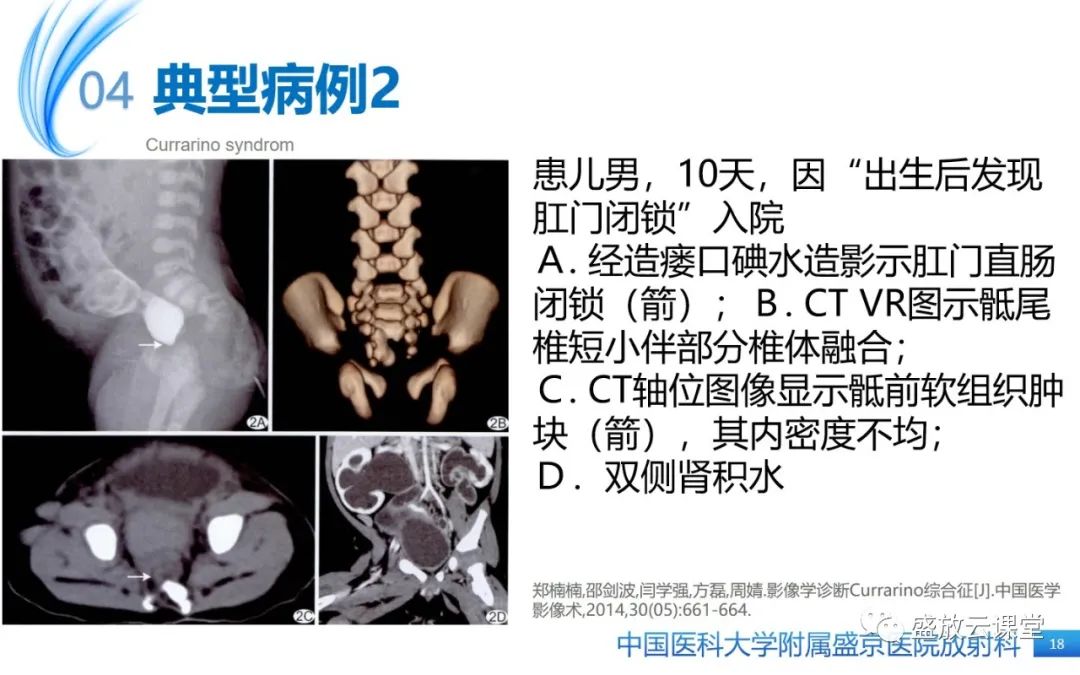 影像PPT - 【病例】Currarino综合征1例CT及MR影像-18
