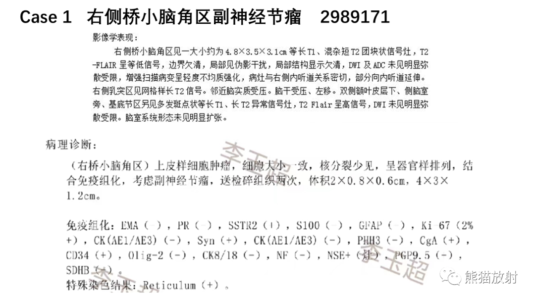 影像PPT - 【病例】桥小脑角区占位—副神经节瘤 VS 室管膜瘤-16