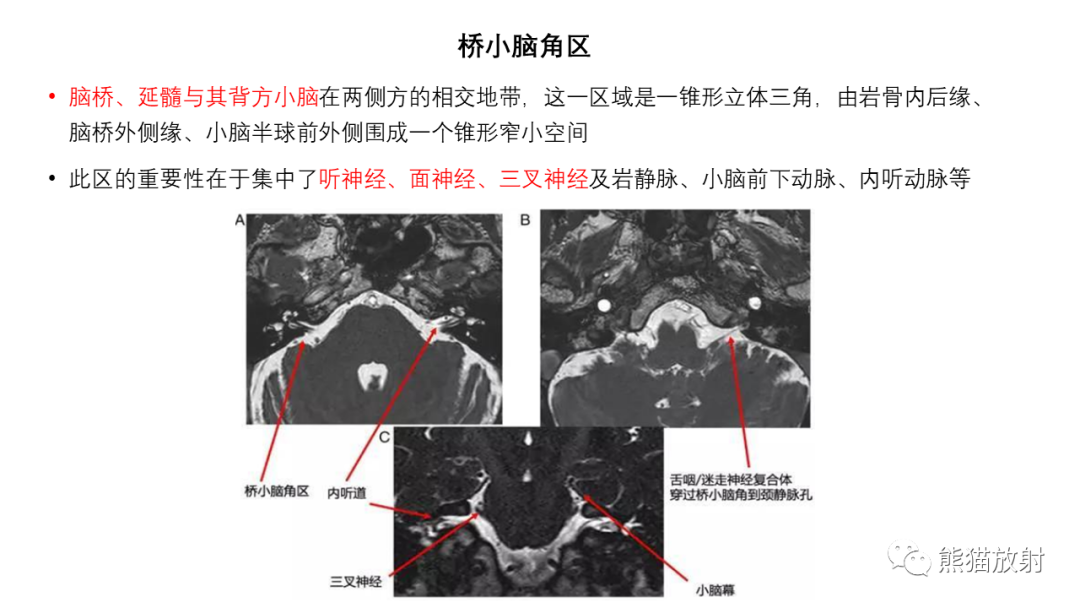 影像PPT - 【病例】桥小脑角区占位—副神经节瘤 VS 室管膜瘤-19