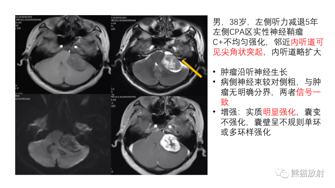 影像PPT - 【病例】桥小脑角区占位—副神经节瘤 VS 室管膜瘤-22