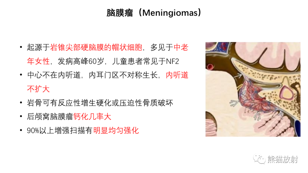 影像PPT - 【病例】桥小脑角区占位—副神经节瘤 VS 室管膜瘤-23