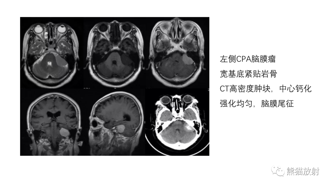 影像PPT - 【病例】桥小脑角区占位—副神经节瘤 VS 室管膜瘤-24