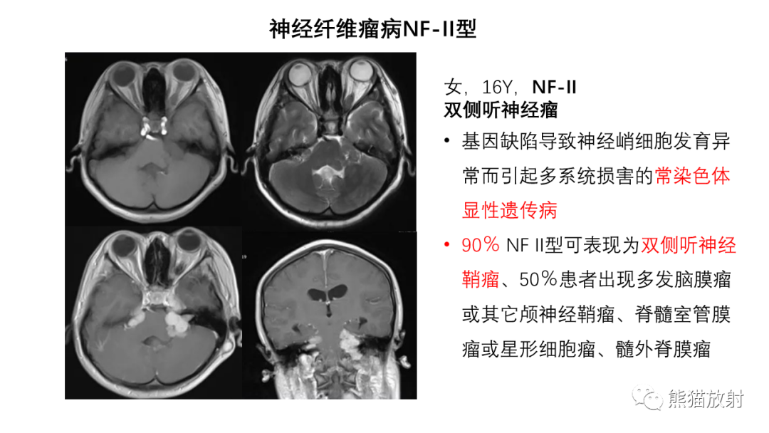 影像PPT - 【病例】桥小脑角区占位—副神经节瘤 VS 室管膜瘤-25