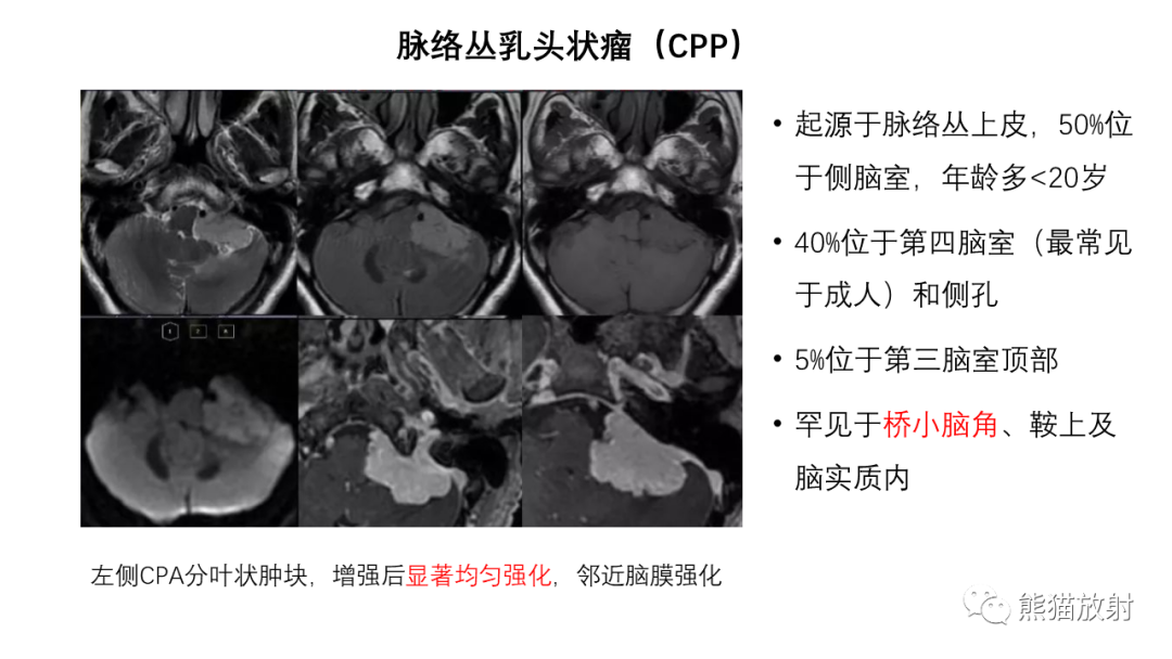影像PPT - 【病例】桥小脑角区占位—副神经节瘤 VS 室管膜瘤-26
