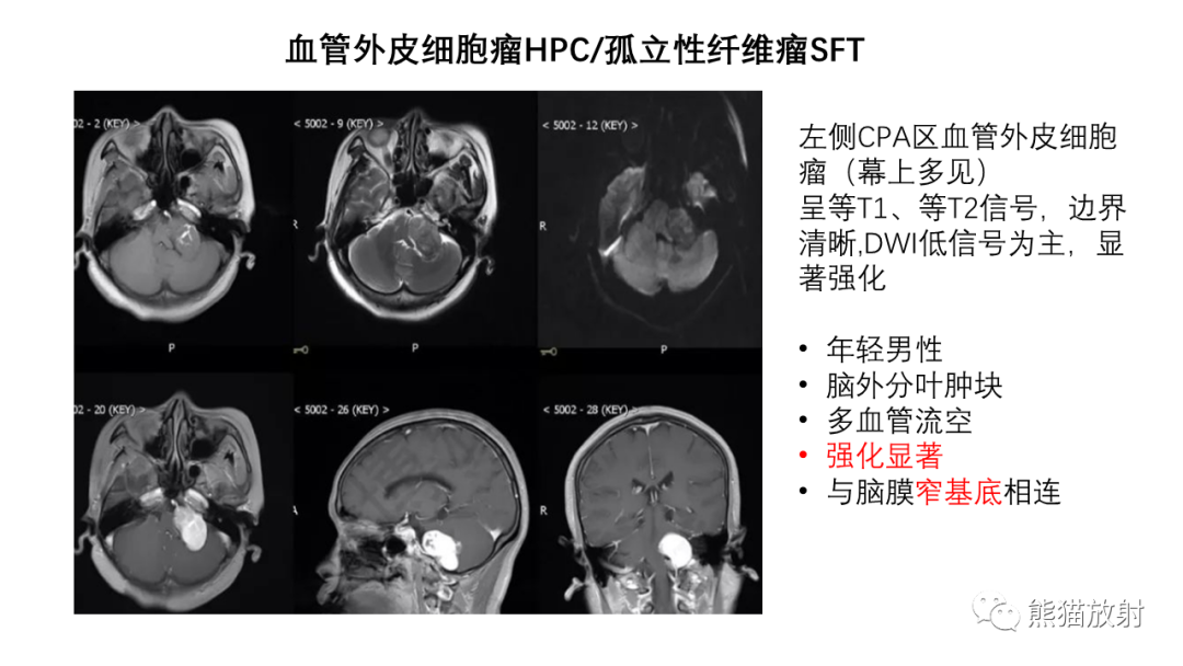 影像PPT - 【病例】桥小脑角区占位—副神经节瘤 VS 室管膜瘤-27