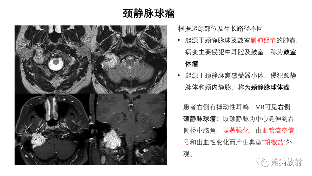 影像PPT - 【病例】桥小脑角区占位—副神经节瘤 VS 室管膜瘤-28